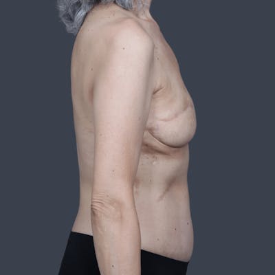 DIEP Flap Before & After Gallery - Patient 309367 - Image 2