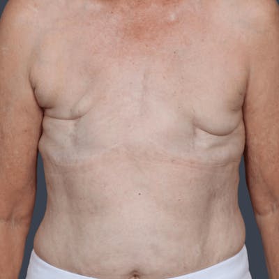 DIEP Flap Before & After Gallery - Patient 365724 - Image 1