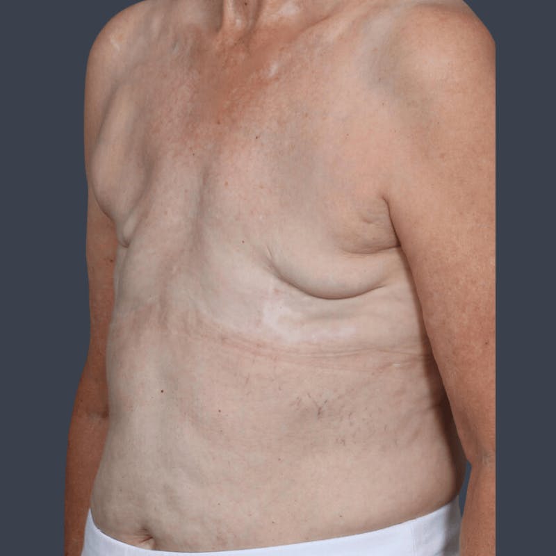 DIEP Flap Before & After Gallery - Patient 365724 - Image 3