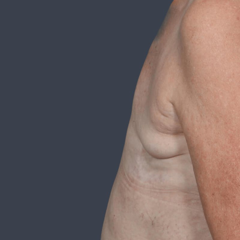 DIEP Flap Before & After Gallery - Patient 365724 - Image 5