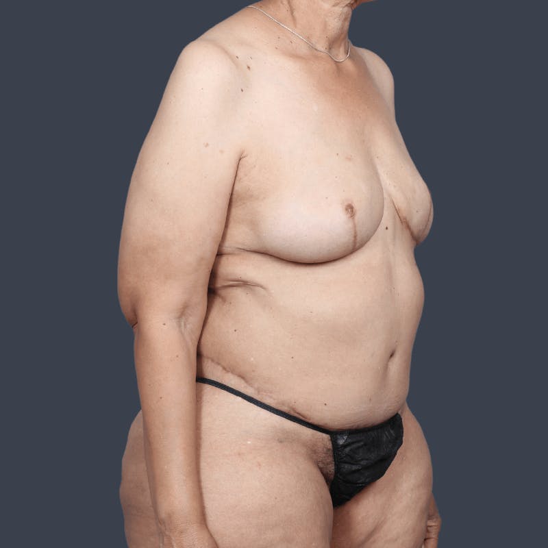 DIEP Flap Before & After Gallery - Patient 178468 - Image 6