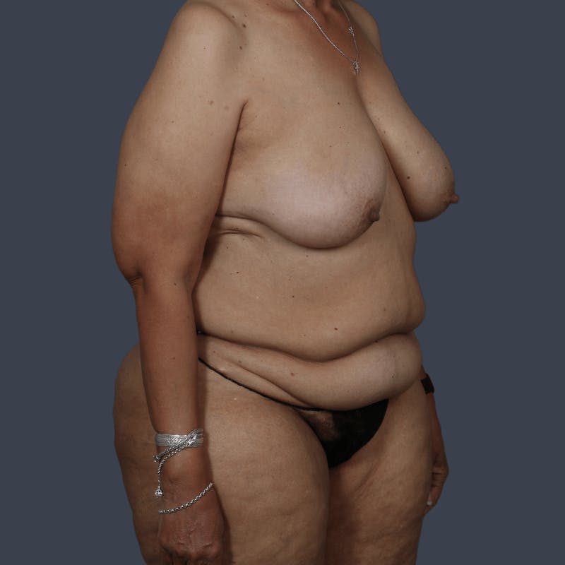DIEP Flap Before & After Gallery - Patient 178468 - Image 5