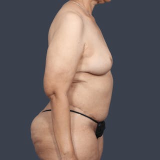 DIEP Flap Before & After Gallery - Patient 178468 - Image 4