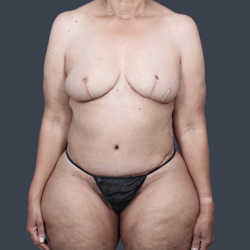 DIEP Flap Before & After Gallery - Patient 178468 - Image 2
