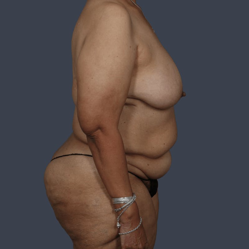 DIEP Flap Before & After Gallery - Patient 178468 - Image 3