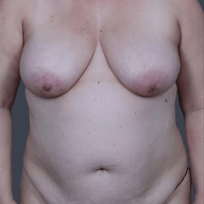 DIEP Flap Before & After Gallery - Patient 331435 - Image 1