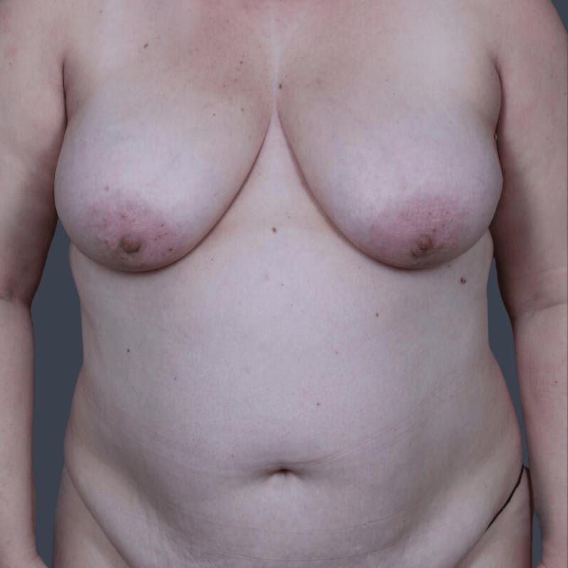 DIEP Flap Before & After Gallery - Patient 331435 - Image 1