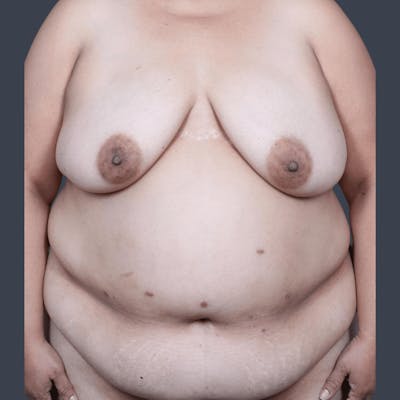 DIEP Flap Before & After Gallery - Patient 182201 - Image 1