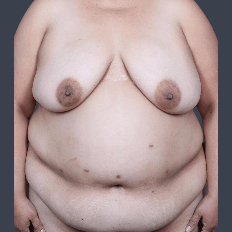 DIEP Flap Before & After Gallery - Patient 182201 - Image 1