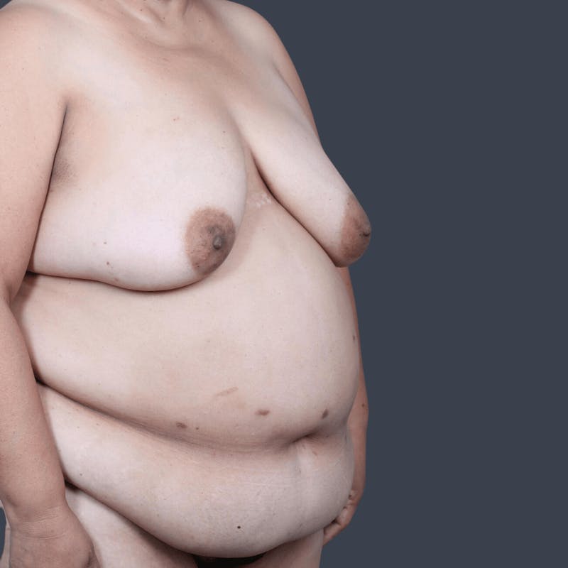 DIEP Flap Before & After Gallery - Patient 182201 - Image 3