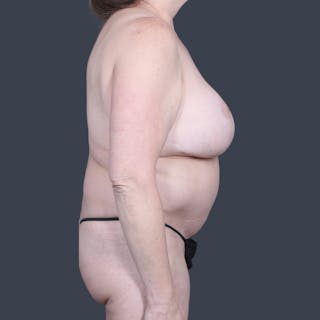 DIEP Flap Before & After Gallery - Patient 795163 - Image 6