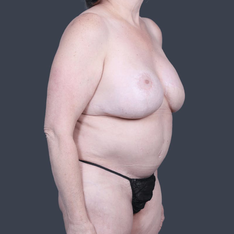 DIEP Flap Before & After Gallery - Patient 795163 - Image 4