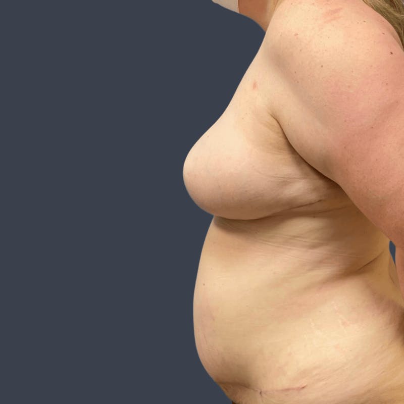 DIEP Flap Before & After Gallery - Patient 100455 - Image 4