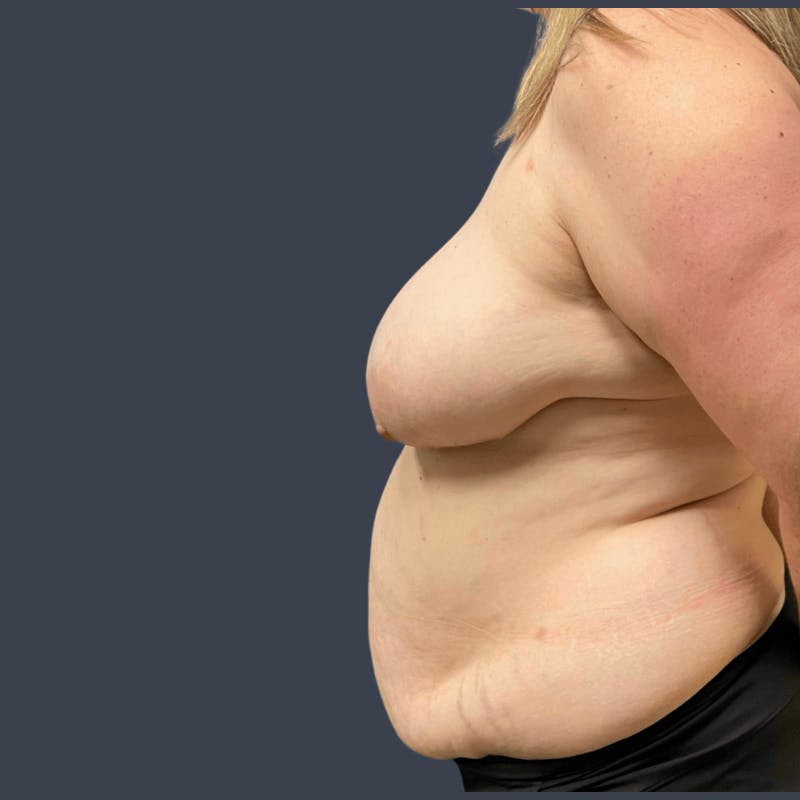 DIEP Flap Before & After Gallery - Patient 100455 - Image 3