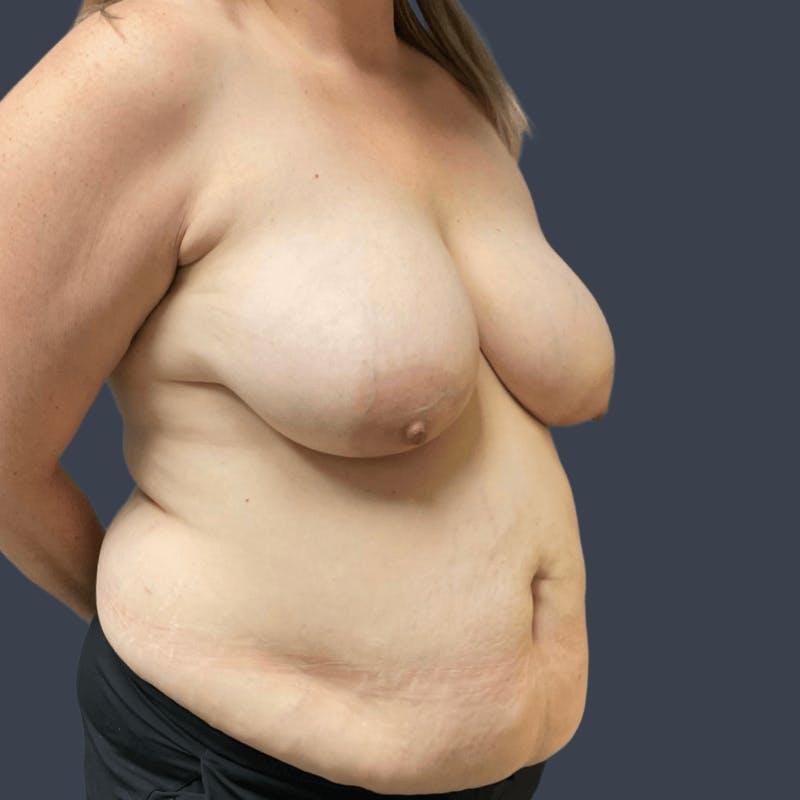 DIEP Flap Before & After Gallery - Patient 100455 - Image 5