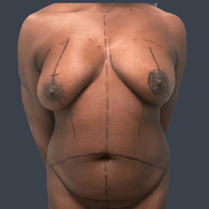 DIEP Flap Before & After Gallery - Patient 119572 - Image 1