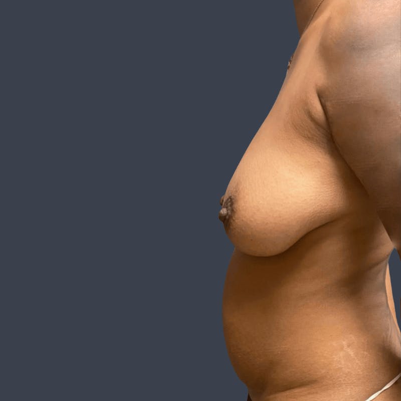 DIEP Flap Before & After Gallery - Patient 104251 - Image 5