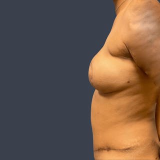 DIEP Flap Before & After Gallery - Patient 104251 - Image 6