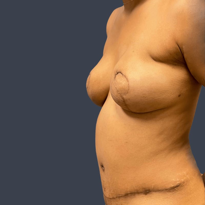DIEP Flap Before & After Gallery - Patient 104251 - Image 4