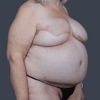 DIEP Flap Before & After Gallery - Patient 721189 - Image 6