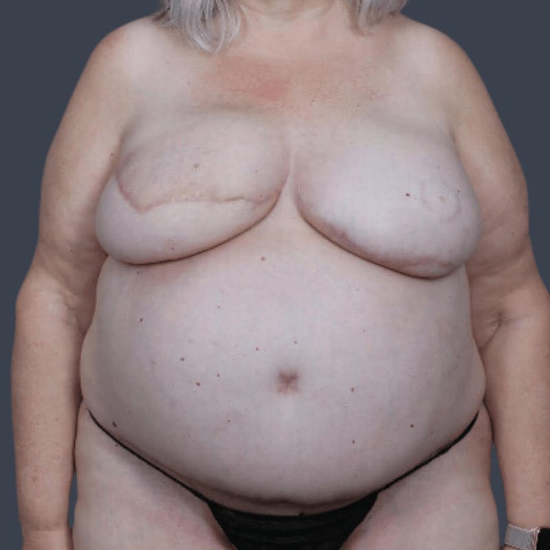 DIEP Flap Before & After Gallery - Patient 721189 - Image 2