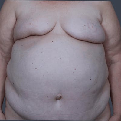 DIEP Flap Before & After Gallery - Patient 721189 - Image 1