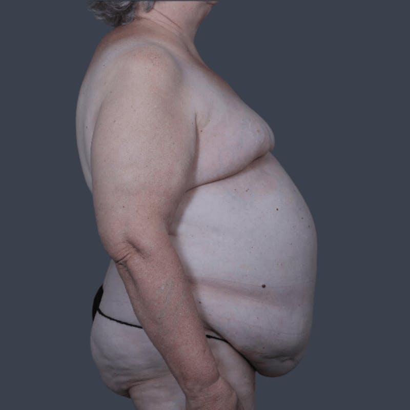 DIEP Flap Before & After Gallery - Patient 721189 - Image 5