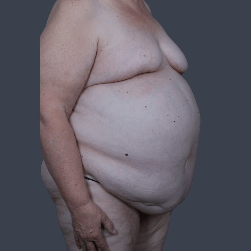 DIEP Flap Before & After Gallery - Patient 721189 - Image 3