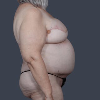 DIEP Flap Before & After Gallery - Patient 721189 - Image 4