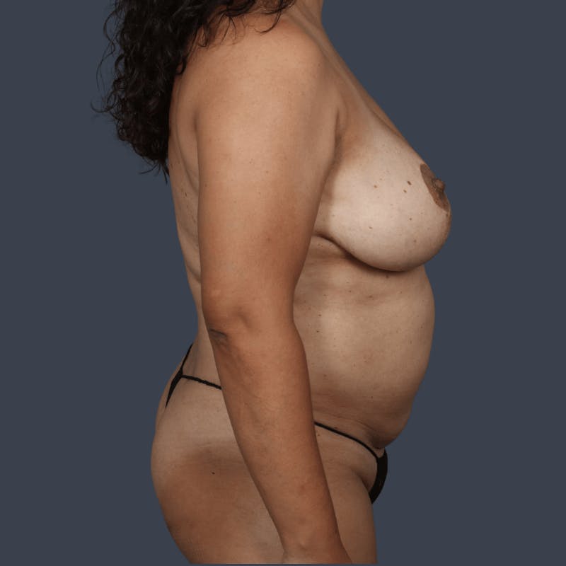 DIEP Flap Before & After Gallery - Patient 151527 - Image 3