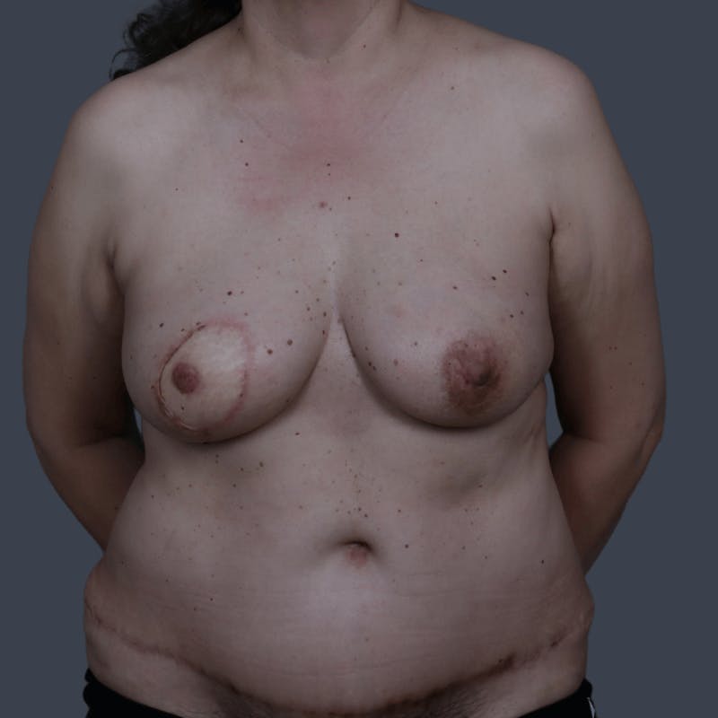 Nipple-Sparing Breast Reconstruction Before & After Gallery - Patient 978148 - Image 4