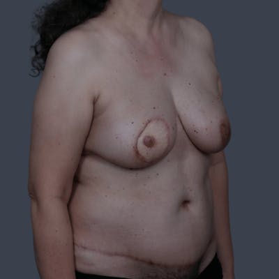 Nipple-Sparing Breast Reconstruction Before & After Gallery - Patient 978148 - Image 2