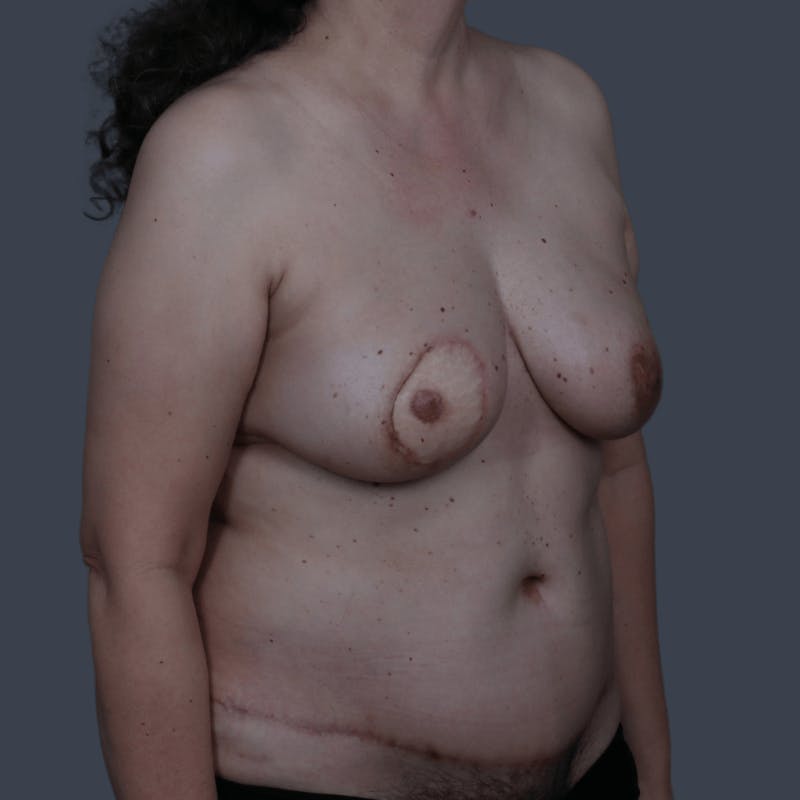 Nipple-Sparing Breast Reconstruction Before & After Gallery - Patient 978148 - Image 2