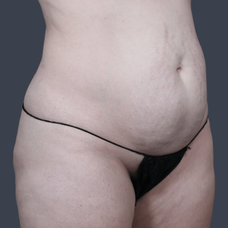 Abdominoplasty / Tummy Tuck Before & After Gallery - Patient 166076 - Image 1