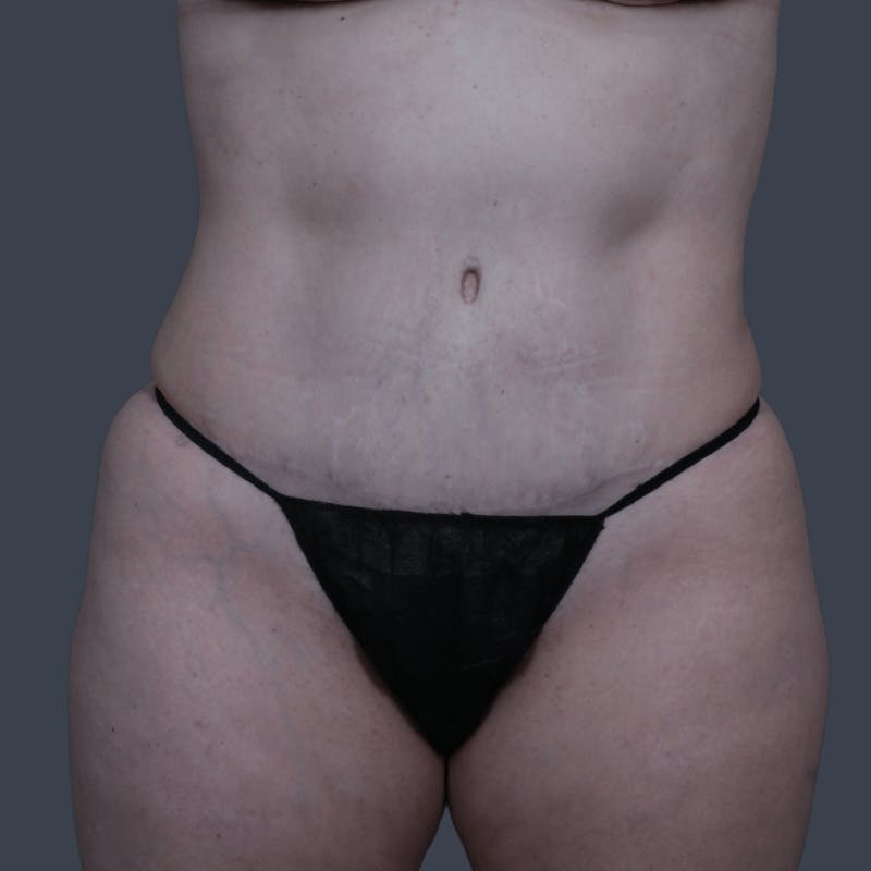 Abdominoplasty / Tummy Tuck Before & After Gallery - Patient 166076 - Image 4