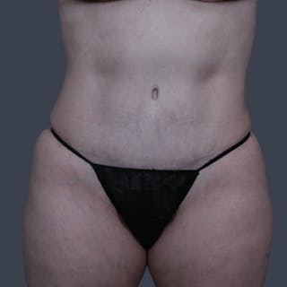 Abdominoplasty / Tummy Tuck Before & After Gallery - Patient 166076 - Image 4