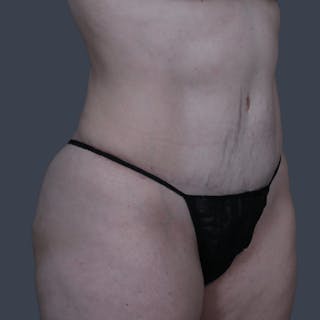 Abdominoplasty / Tummy Tuck Before & After Gallery - Patient 166076 - Image 2