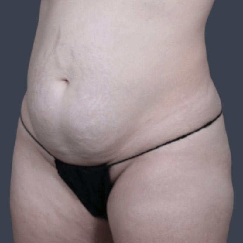 Abdominoplasty / Tummy Tuck Before & After Gallery - Patient 166076 - Image 5