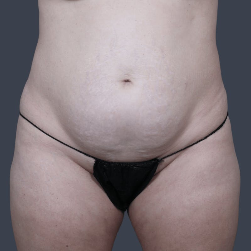 Abdominoplasty / Tummy Tuck Before & After Gallery - Patient 166076 - Image 3