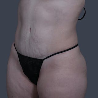 Abdominoplasty / Tummy Tuck Before & After Gallery - Patient 166076 - Image 6