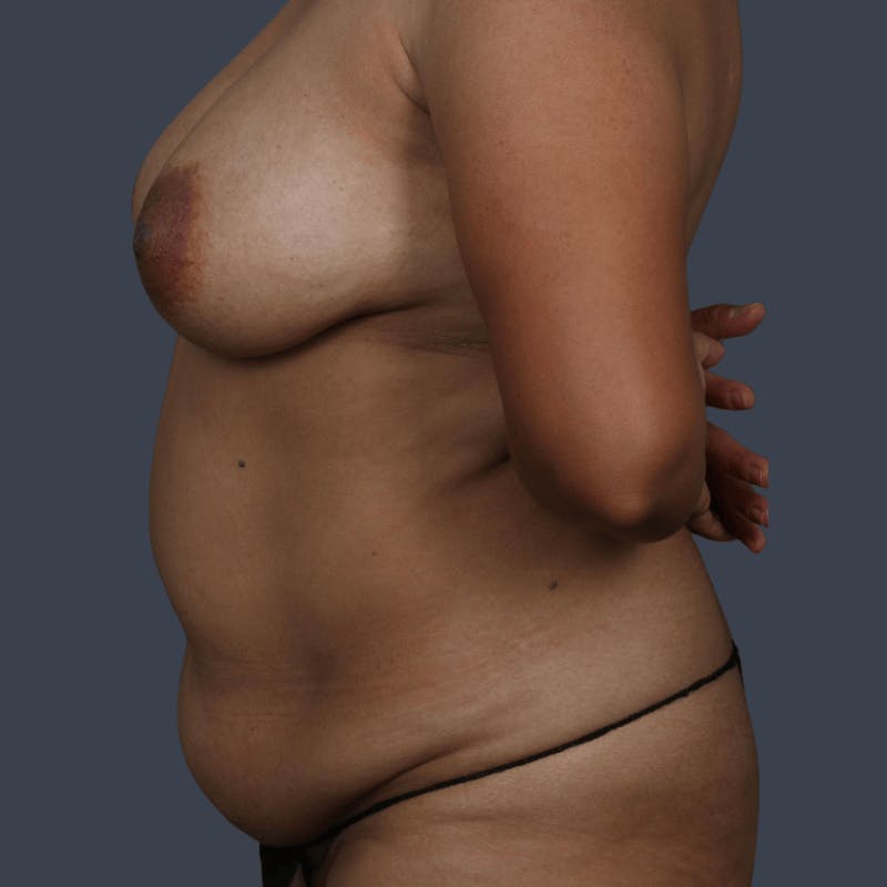Abdominoplasty / Tummy Tuck Before & After Gallery - Patient 797619 - Image 5