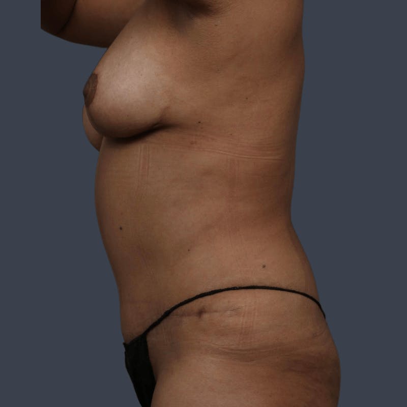 Abdominoplasty / Tummy Tuck Before & After Gallery - Patient 797619 - Image 6