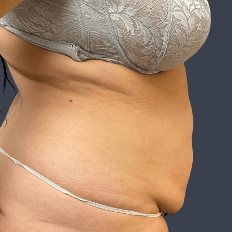 Liposuction Before & After Gallery - Patient 322185 - Image 3