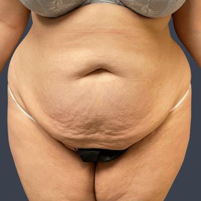 Liposuction Before & After Gallery - Patient 322185 - Image 1