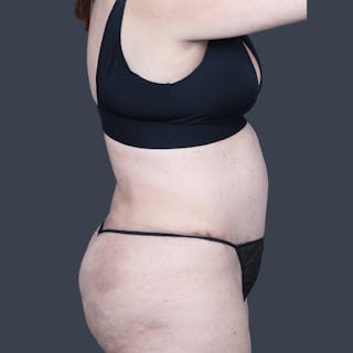 Abdominoplasty / Tummy Tuck Before & After Gallery - Patient 359830 - Image 4