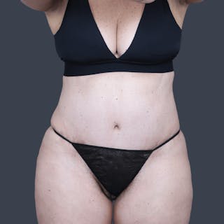 Abdominoplasty / Tummy Tuck Before & After Gallery - Patient 359830 - Image 2