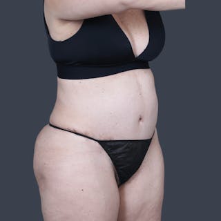 Abdominoplasty / Tummy Tuck Before & After Gallery - Patient 359830 - Image 6