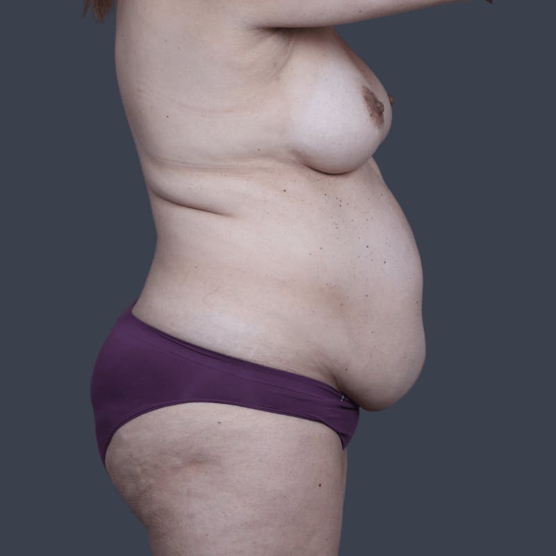 Abdominoplasty / Tummy Tuck Before & After Gallery - Patient 359830 - Image 5