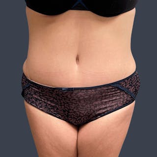 Abdominoplasty / Tummy Tuck Before & After Gallery - Patient 411689 - Image 2