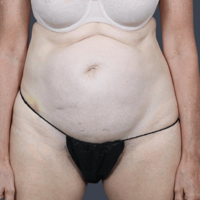 Abdominoplasty / Tummy Tuck Before & After Gallery - Patient 136756 - Image 1